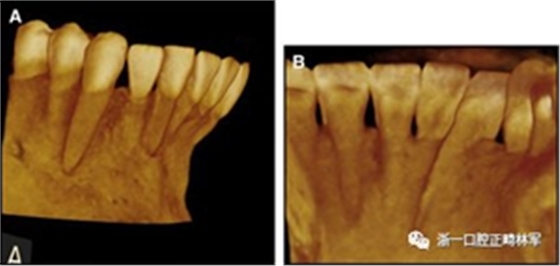 正畸文獻(xiàn)閱讀--固定舌側(cè)保持器作用下意外的牙齒移動(dòng) 正畸文獻(xiàn)閱讀--固定舌側(cè)保持器作用下意外的牙齒移動(dòng)