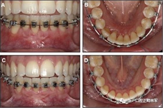 正畸文獻(xiàn)閱讀--固定舌側(cè)保持器作用下意外的牙齒移動(dòng) 正畸文獻(xiàn)閱讀--固定舌側(cè)保持器作用下意外的牙齒移動(dòng)