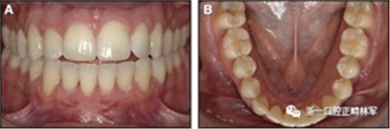 正畸文獻(xiàn)閱讀--固定舌側(cè)保持器作用下意外的牙齒移動(dòng) 正畸文獻(xiàn)閱讀--固定舌側(cè)保持器作用下意外的牙齒移動(dòng)