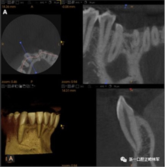 正畸文獻(xiàn)閱讀--固定舌側(cè)保持器作用下意外的牙齒移動(dòng) 正畸文獻(xiàn)閱讀--固定舌側(cè)保持器作用下意外的牙齒移動(dòng)