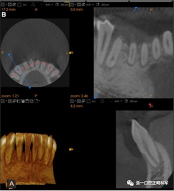 正畸文獻(xiàn)閱讀--固定舌側(cè)保持器作用下意外的牙齒移動(dòng) 正畸文獻(xiàn)閱讀--固定舌側(cè)保持器作用下意外的牙齒移動(dòng)