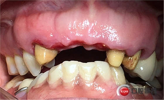 上前牙骨量不足種植+信封式植骨（梁光強(qiáng)）