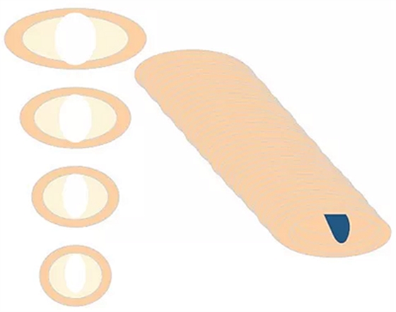 知識(shí)分享:規(guī)范化根管治療的細(xì)節(jié)分析 知識(shí)分享:規(guī)范化根管治療的細(xì)節(jié)分析