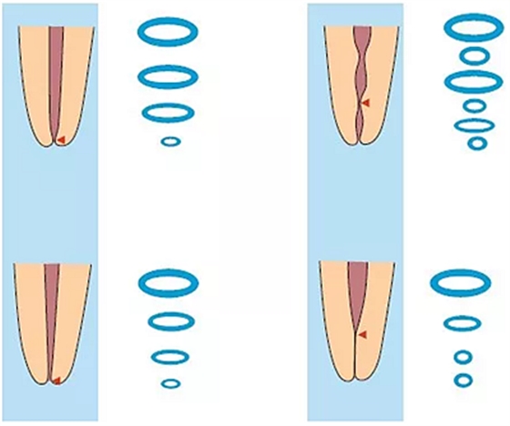知識(shí)分享:規(guī)范化根管治療的細(xì)節(jié)分析 知識(shí)分享:規(guī)范化根管治療的細(xì)節(jié)分析
