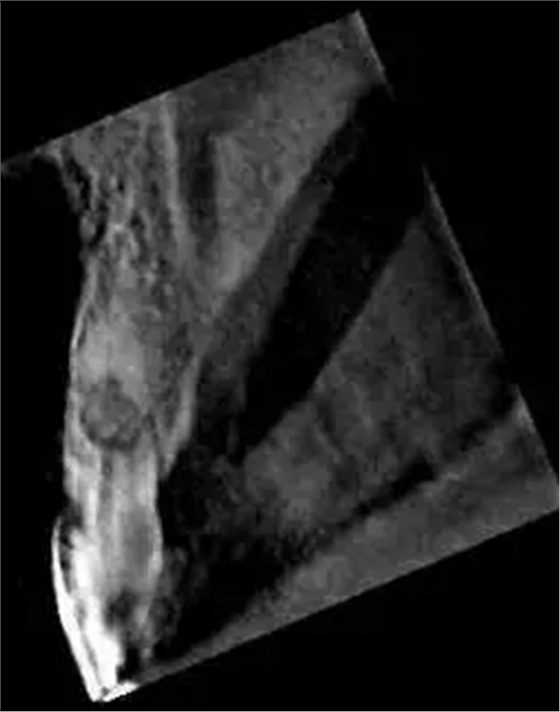 伴隨根管內(nèi)鈣化物形成牙根內(nèi)吸收治療1例 伴隨根管內(nèi)鈣化物形成牙根內(nèi)吸收治療1例