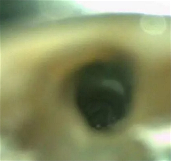 伴隨根管內(nèi)鈣化物形成牙根內(nèi)吸收治療1例 伴隨根管內(nèi)鈣化物形成牙根內(nèi)吸收治療1例