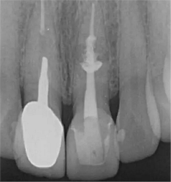 伴隨根管內(nèi)鈣化物形成牙根內(nèi)吸收治療1例 伴隨根管內(nèi)鈣化物形成牙根內(nèi)吸收治療1例