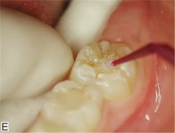 預(yù)防齲齒，口腔醫(yī)生能幫我做什么？局部用氟、窩溝封閉、預(yù)防性樹脂充填都是什么？