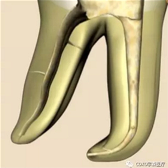 知識分享:根管治療的標(biāo)準(zhǔn)步驟 知識分享:根管治療的標(biāo)準(zhǔn)步驟