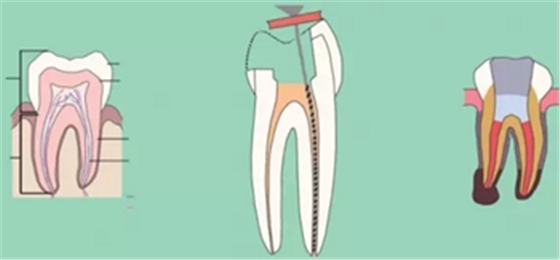 知識分享:根管治療的標(biāo)準(zhǔn)步驟 知識分享:根管治療的標(biāo)準(zhǔn)步驟