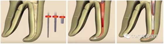 知識分享:根管治療的標(biāo)準(zhǔn)步驟 知識分享:根管治療的標(biāo)準(zhǔn)步驟