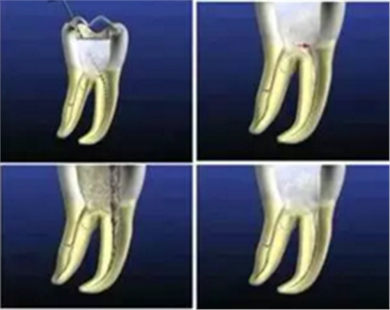 知識分享:根管治療的標(biāo)準(zhǔn)步驟 知識分享:根管治療的標(biāo)準(zhǔn)步驟