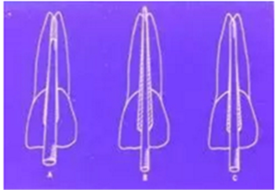 知識分享:根管治療的標(biāo)準(zhǔn)步驟 知識分享:根管治療的標(biāo)準(zhǔn)步驟