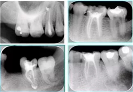 知識分享:根管治療的標(biāo)準(zhǔn)步驟 知識分享:根管治療的標(biāo)準(zhǔn)步驟