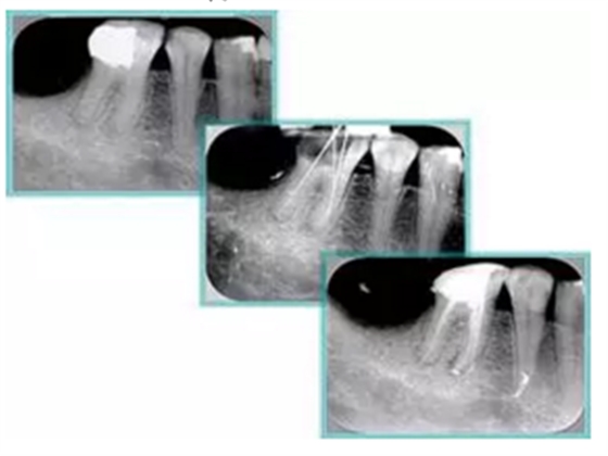 知識分享:根管治療的標(biāo)準(zhǔn)步驟 知識分享:根管治療的標(biāo)準(zhǔn)步驟