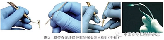 專題筆談 | 內窺鏡在牙周診療中的應用進展 專題筆談 | 內窺鏡在牙周診療中的應用進展