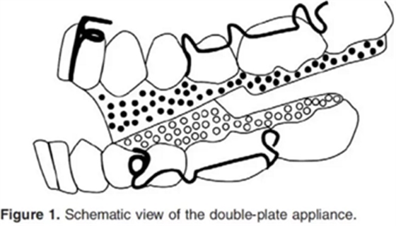 正畸文獻(xiàn)賞析--活動矯治器在III類患者中的應(yīng)用 正畸文獻(xiàn)賞析--活動矯治器在III類患者中的應(yīng)用