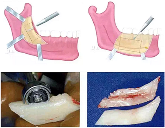 種植手術(shù)的12個(gè)重要操作JXA.png 種植手術(shù)的12個(gè)重要操作JXA.png