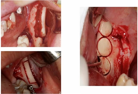 種植手術(shù)的12個(gè)重要操作 種植手術(shù)的12個(gè)重要操作