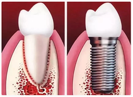 種植牙常見問答你知道多少？