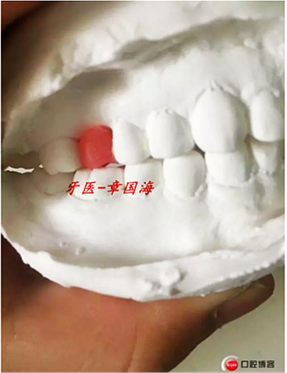 種植導(dǎo)板制作 種植導(dǎo)板制作