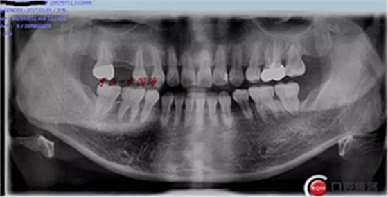種植導(dǎo)板制作 種植導(dǎo)板制作