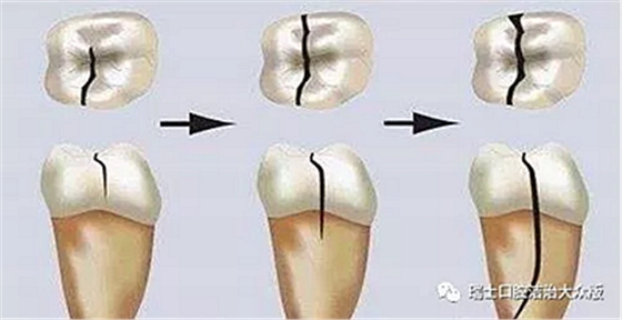 成人牙齒外傷了怎么應急處理？