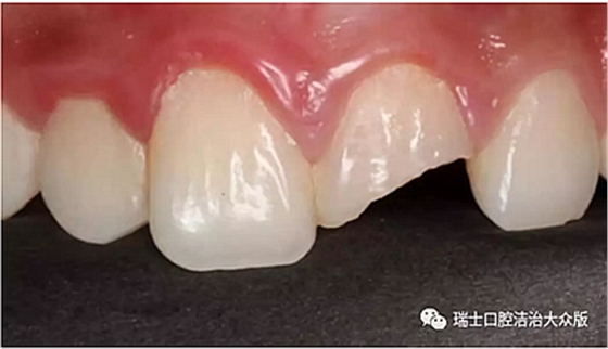 成人牙齒外傷了怎么應急處理？