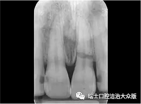 成人牙齒外傷了怎么應急處理？