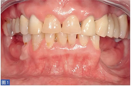 柵欄技術(shù)用于局部三維骨增量 &mdash;技術(shù)概述與病例匯報(bào) （1）