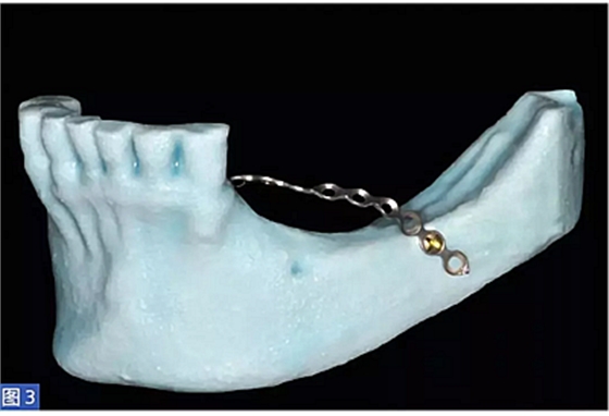 柵欄技術(shù)用于局部三維骨增量 &mdash;技術(shù)概述與病例匯報(bào) （1）