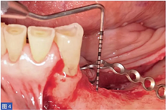 柵欄技術(shù)用于局部三維骨增量 &mdash;技術(shù)概述與病例匯報(bào) （1）