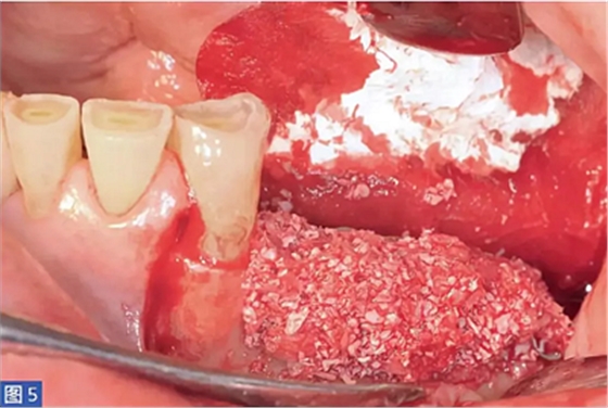 柵欄技術(shù)用于局部三維骨增量 &mdash;技術(shù)概述與病例匯報(bào) （1）