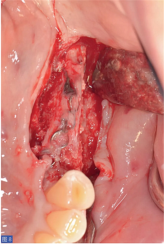 柵欄技術(shù)用于局部三維骨增量 &mdash;技術(shù)概述與病例匯報(bào) （1）