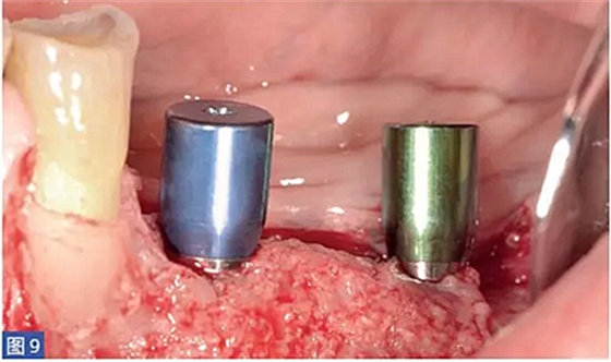 柵欄技術(shù)用于局部三維骨增量 &mdash;技術(shù)概述與病例匯報(bào) （1）