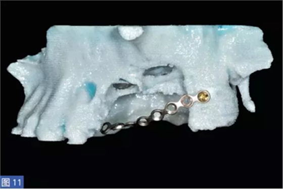 柵欄技術(shù)用于局部三維骨增量 &mdash;技術(shù)概述與病例匯報(bào) （1）