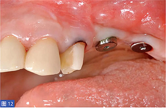 柵欄技術(shù)用于局部三維骨增量 &mdash;技術(shù)概述與病例匯報(bào) （1）