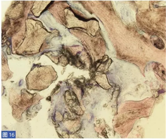  柵欄技術(shù)用于局部三維骨增量 &mdash;技術(shù)概述與病例匯報(bào) （2）