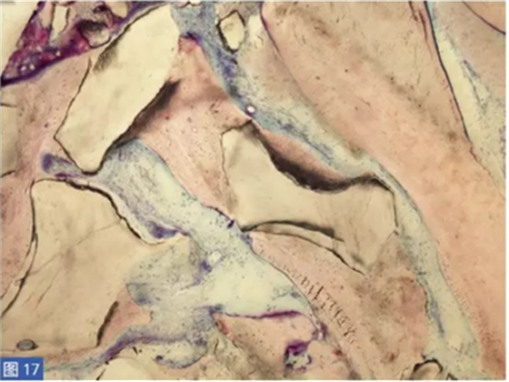  柵欄技術(shù)用于局部三維骨增量 &mdash;技術(shù)概述與病例匯報(bào) （2）