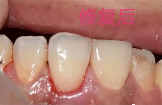 什么是牙齒楔缺？