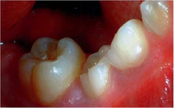 文獻(xiàn)直達(dá)|乳磨牙下沉的臨床管理 文獻(xiàn)直達(dá)|乳磨牙下沉的臨床管理