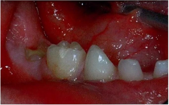 文獻(xiàn)直達(dá)|乳磨牙下沉的臨床管理 文獻(xiàn)直達(dá)|乳磨牙下沉的臨床管理