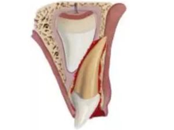 臨床實(shí)踐|乳牙外傷處理指引(值得兒牙醫(yī)生收藏) 臨床實(shí)踐|乳牙外傷處理指引(值得兒牙醫(yī)生收藏)