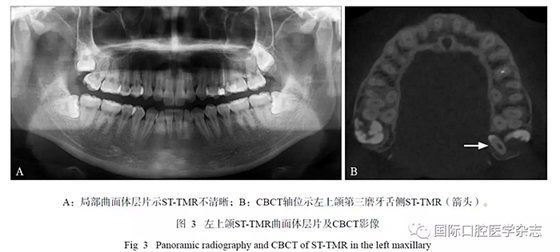 46例患者第三磨牙區(qū)多生牙的影像學(xué)分析 46例患者第三磨牙區(qū)多生牙的影像學(xué)分析