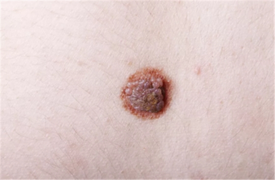 嘴巴里黑黑的好像長(zhǎng)了「痣」？你要當(dāng)心了