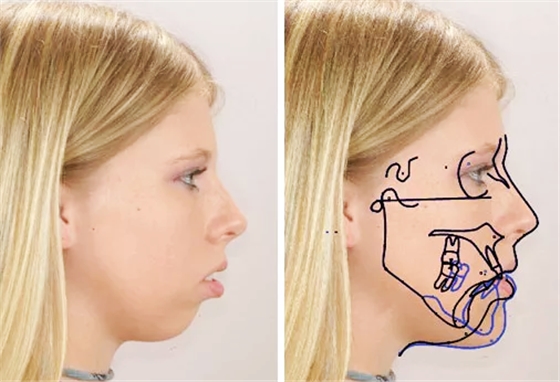 孩子必須換完牙才開(kāi)始整牙嗎？關(guān)于兒童正畸你應(yīng)該知道這些&hellip;&hellip;