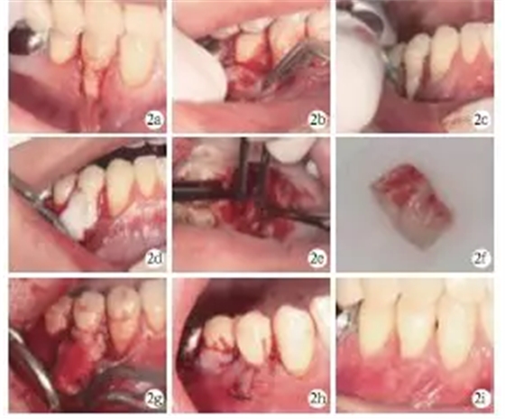 側(cè)向轉(zhuǎn)位瓣結(jié)合上皮下結(jié)締組織移植治療重度MillerⅢ&deg;牙齦退縮1例