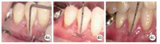 側(cè)向轉(zhuǎn)位瓣結(jié)合上皮下結(jié)締組織移植治療重度MillerⅢ&deg;牙齦退縮1例