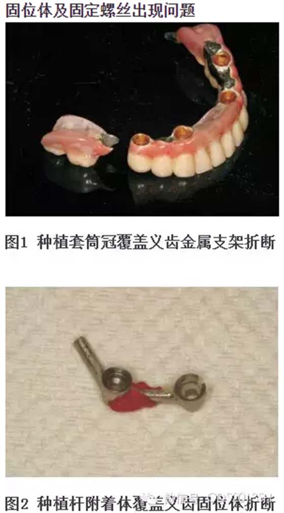 【經(jīng)驗(yàn)分享】無牙頜種植修復(fù)固位的并發(fā)癥與處理&mdash;&mdash;宋應(yīng)亮教授