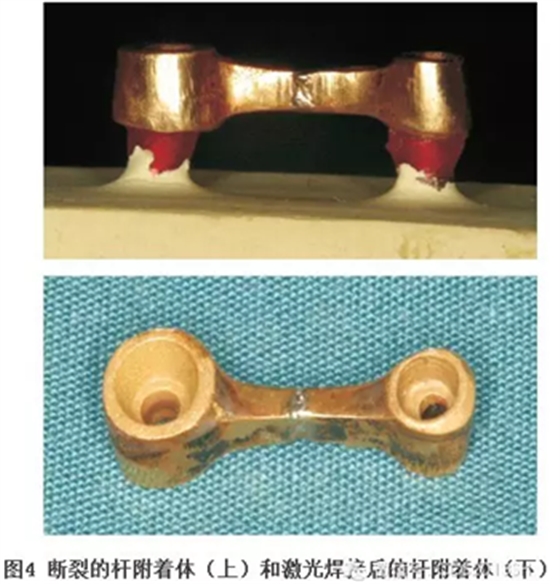 【經(jīng)驗(yàn)分享】無牙頜種植修復(fù)固位的并發(fā)癥與處理&mdash;&mdash;宋應(yīng)亮教授